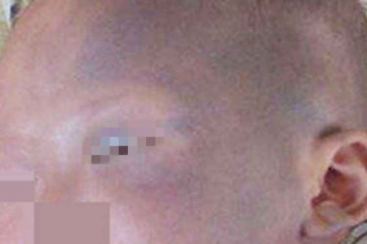 太田痣初期症状图