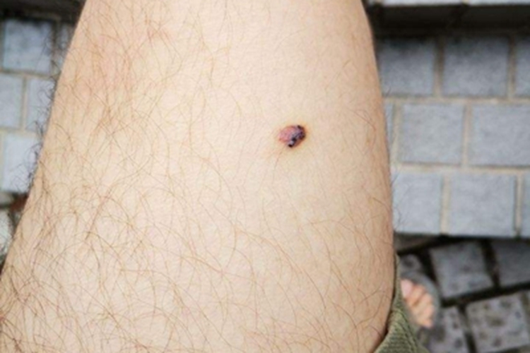 结节性黑素瘤小腿结节图 结节性黑素瘤小腿结节图
