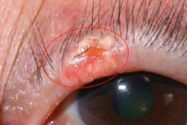 斑块皮损图 斑块皮损图