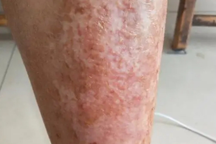 苔藓样淀粉样变病小疙瘩图