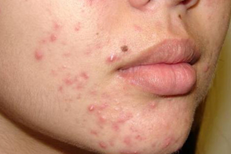 聚合性痤疮面部脓疱图