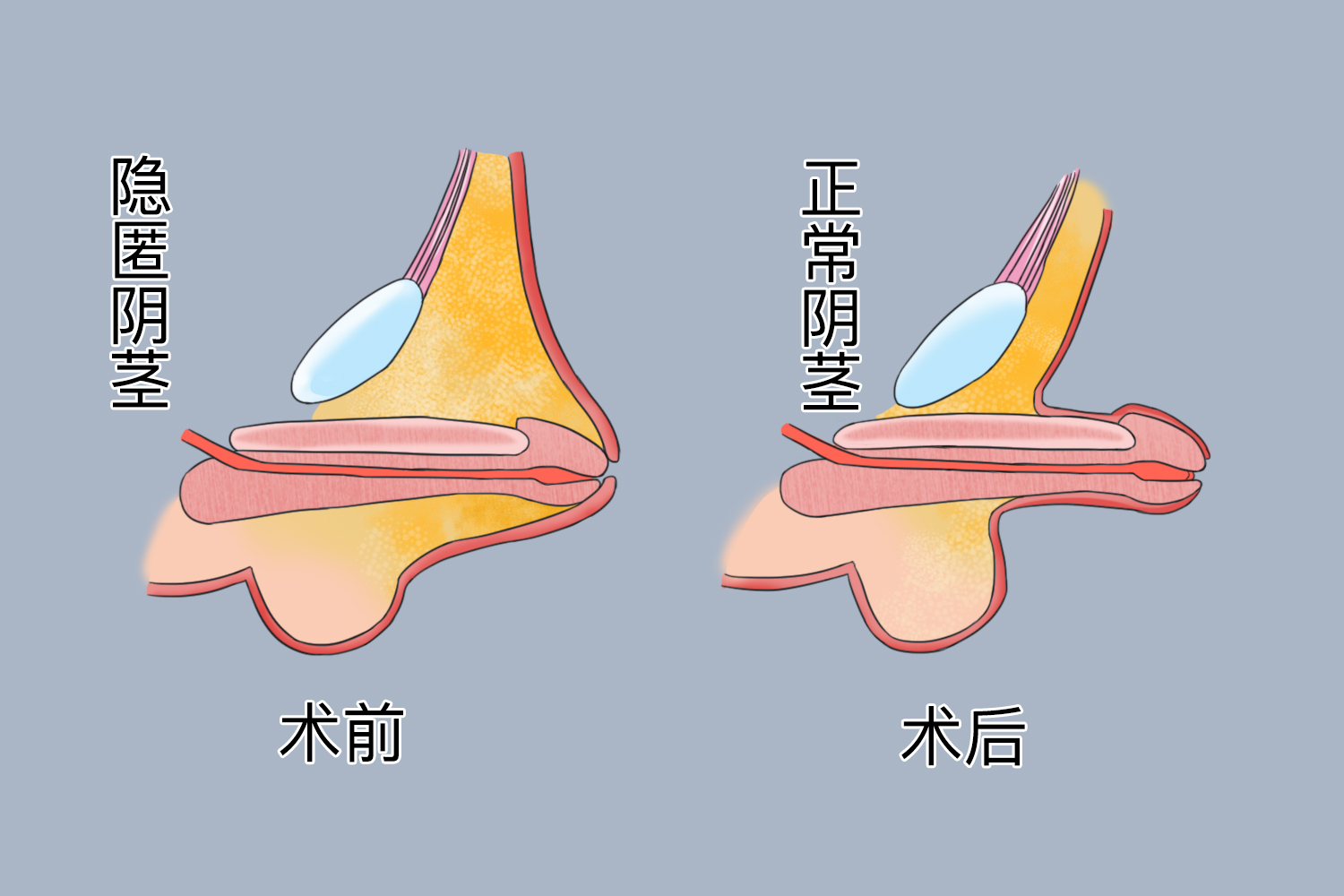 隐匿阴茎手术前后对比图