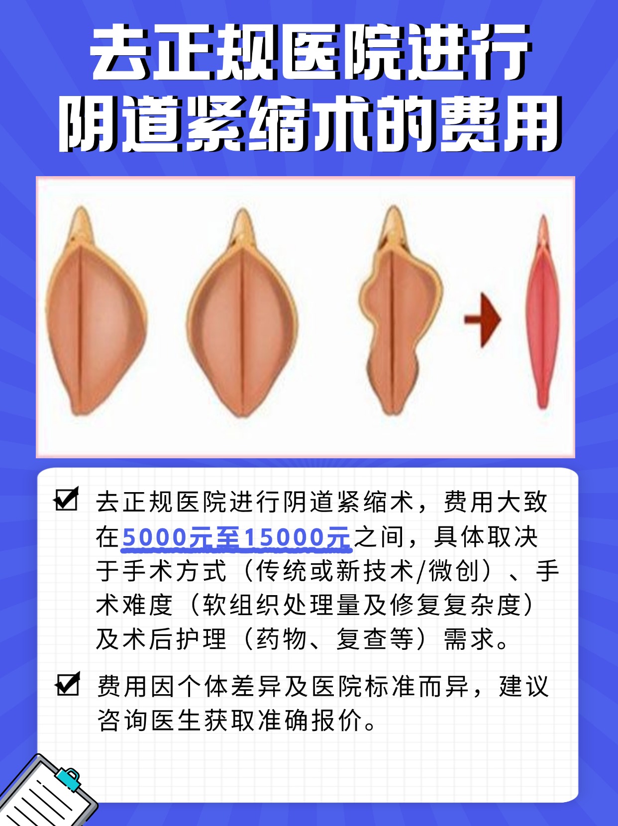 去正规医院进行阴道紧缩术，费用是多少