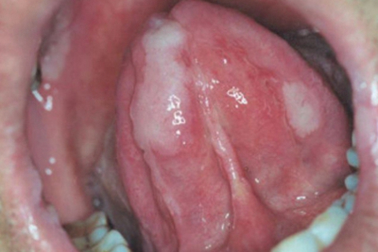 女性二期梅毒舌头症状图 女性二期梅毒舌头症状图