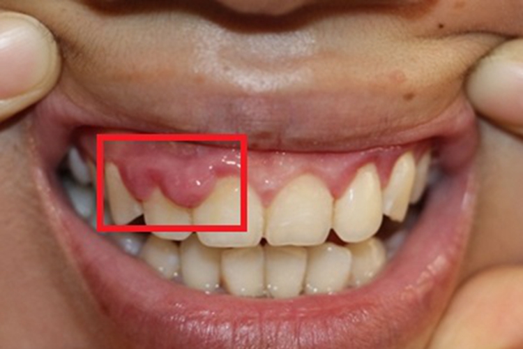 牙龈瘤上牙龈长肉球图