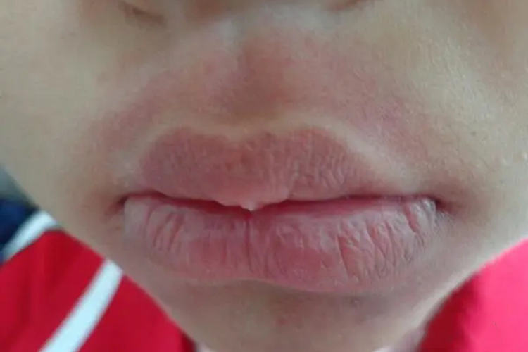 嘴巴过敏红斑图 嘴巴过敏红斑图