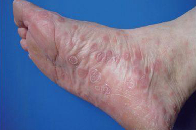 梅毒脚底红斑图片