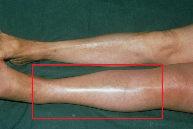 大腿静脉血栓图