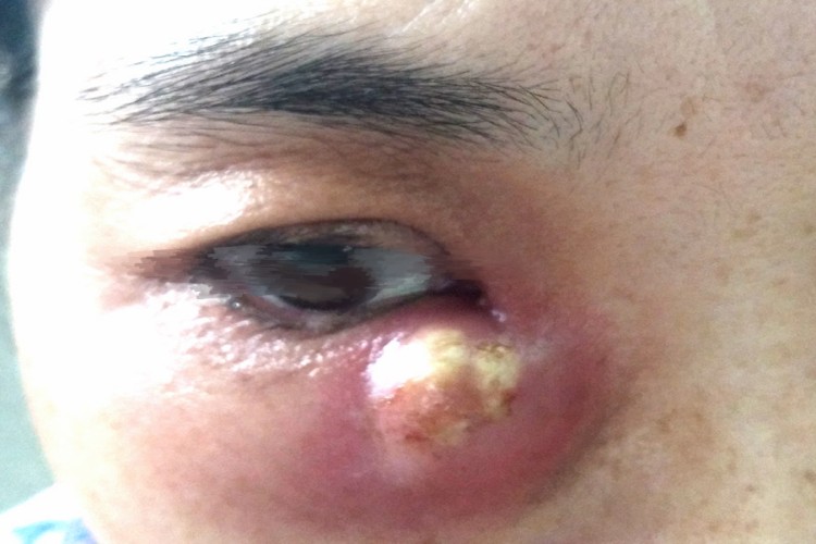 慢性泪囊炎眼周症状图