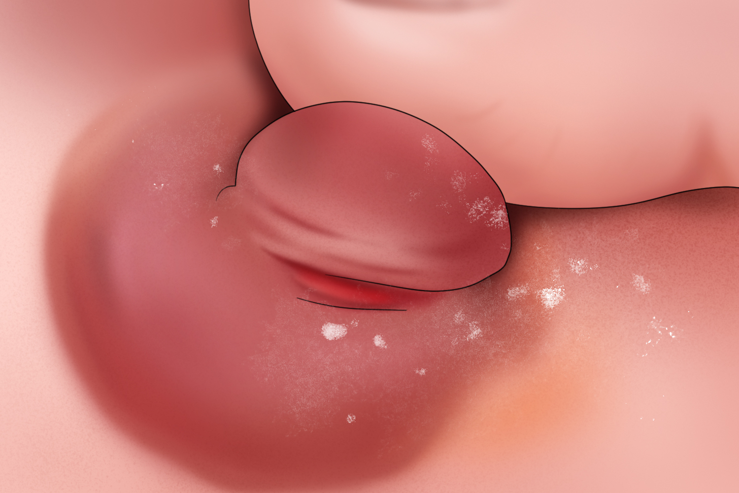 乳头皲裂图 乳头皲裂图