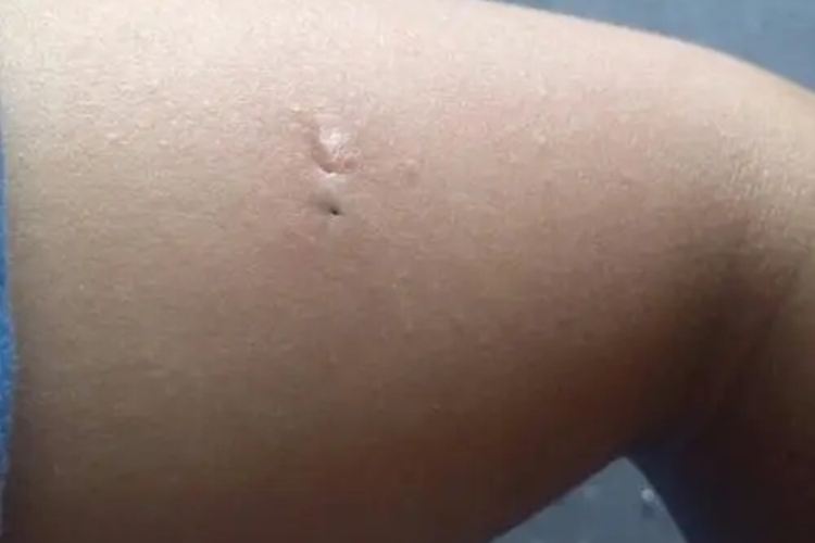 皮脂腺囊肿小洞眼图