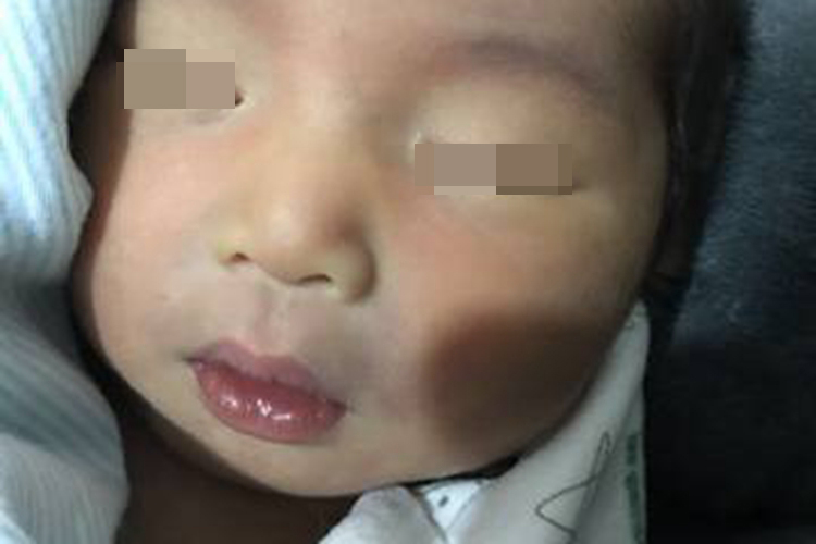 急性喉炎口周发青表现图 急性喉炎口周发青表现图