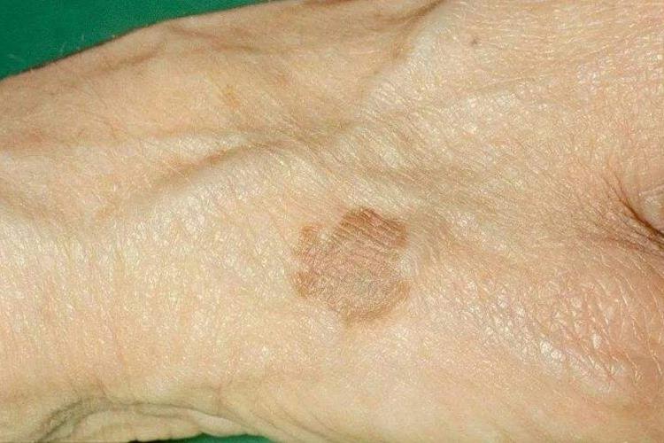 手背脂溢性角化褐色斑图
