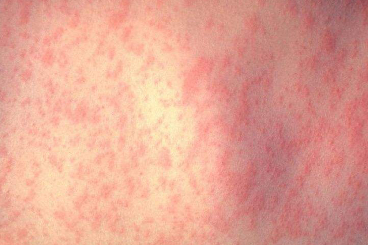 麻疹出疹期皮疹图