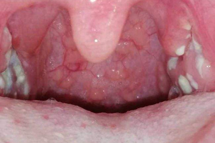急性化脓性扁桃体炎白斑图 急性化脓性扁桃体炎白斑图