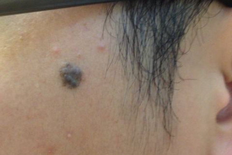 口腔颌面部恶性黑色素瘤结节图 口腔颌面部恶性黑色素瘤结节图