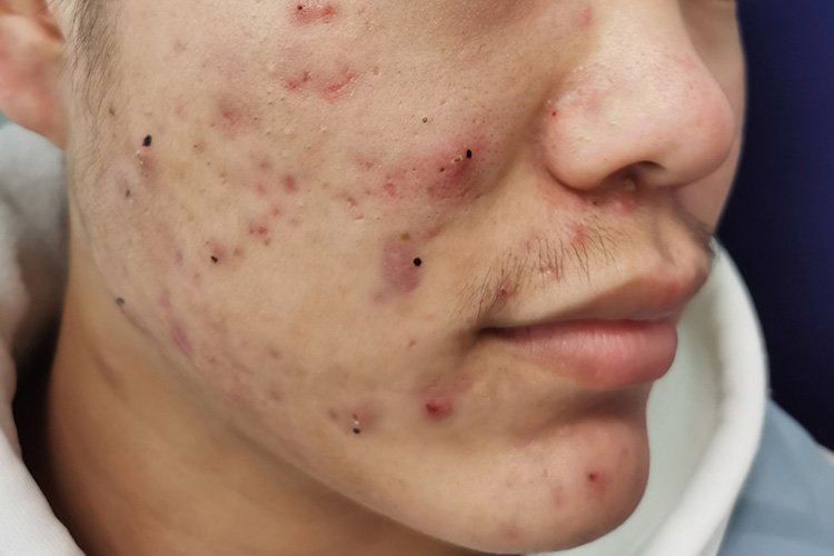男性面部疥疮丘疹图