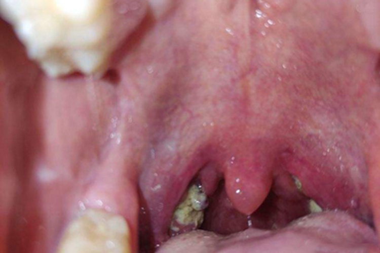 化脓性扁桃体炎扁桃体化脓图 化脓性扁桃体炎扁桃体化脓图
