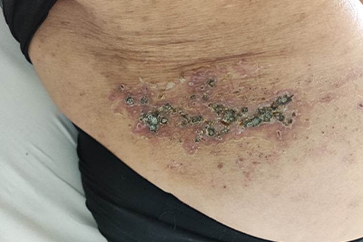 带状疱疹腰上结了黑痂图