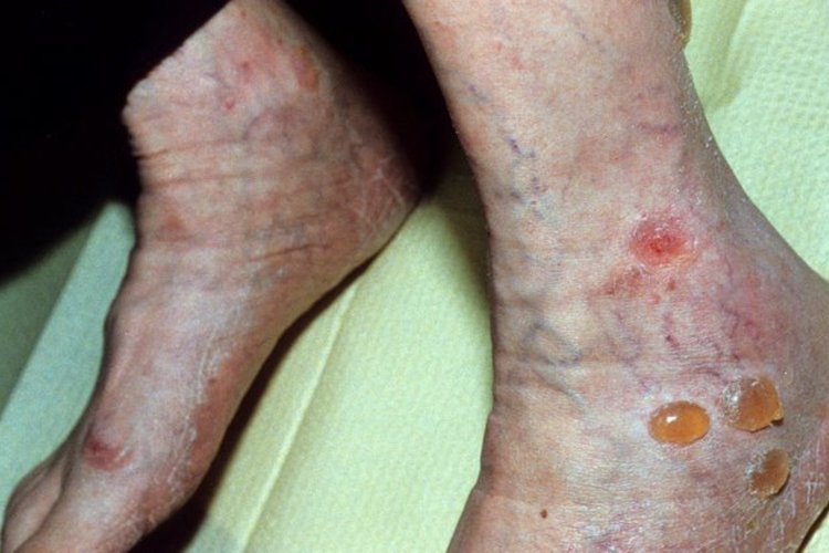 糖尿病合并皮肤瘙痒症图 糖尿病合并皮肤瘙痒症图