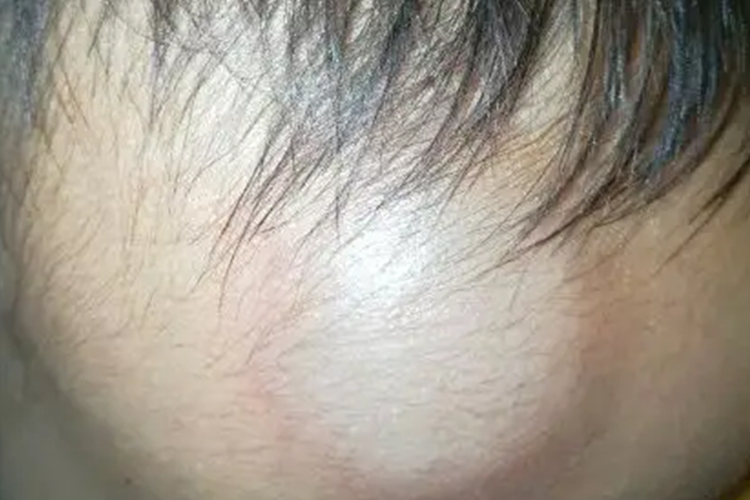 帽状腱膜下血肿图