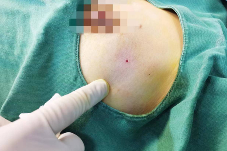 乳腺结节微创手术刀口图 乳腺结节微创手术刀口图