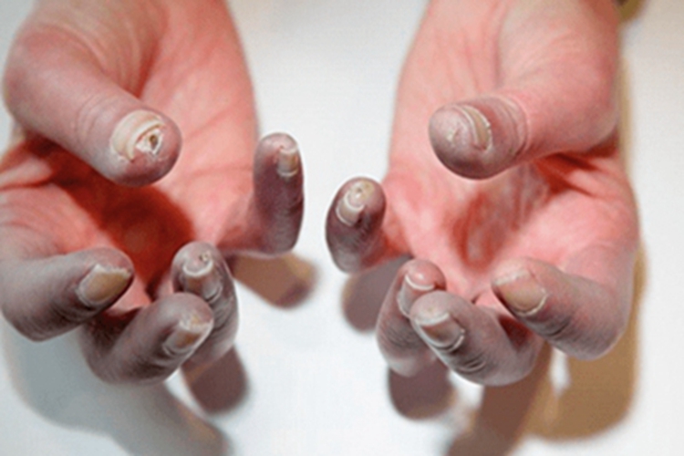 混合性结缔组织病手指尖症状图