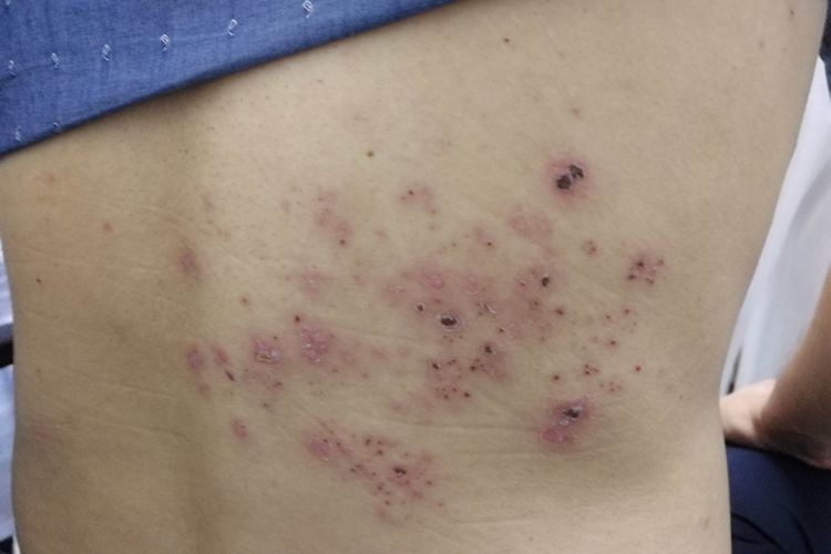 带状疱疹位置示意图