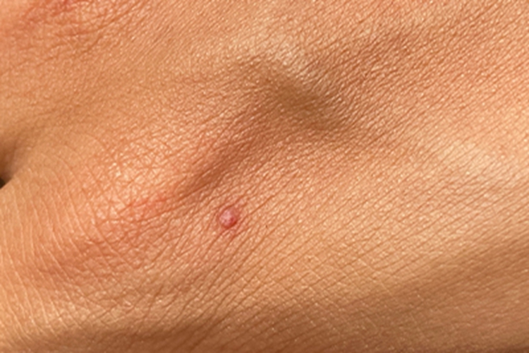 血管瘤手背症状图