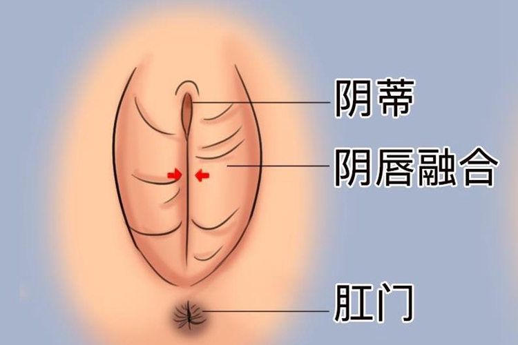 女婴阴唇粘连图