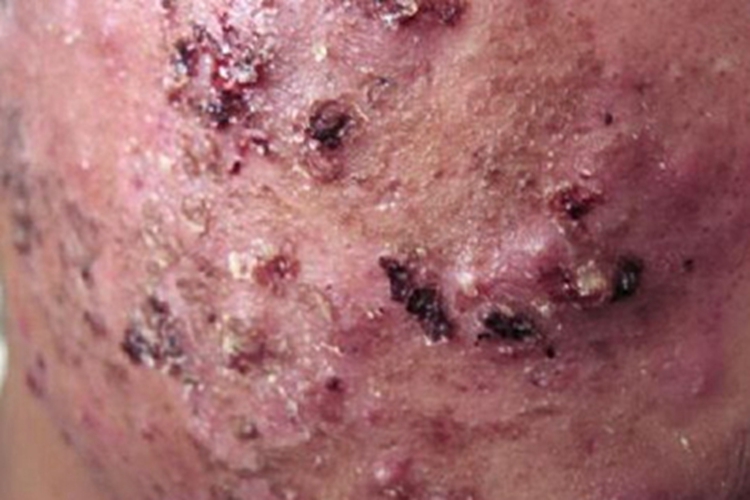 寻常痤疮暗红色结痂图