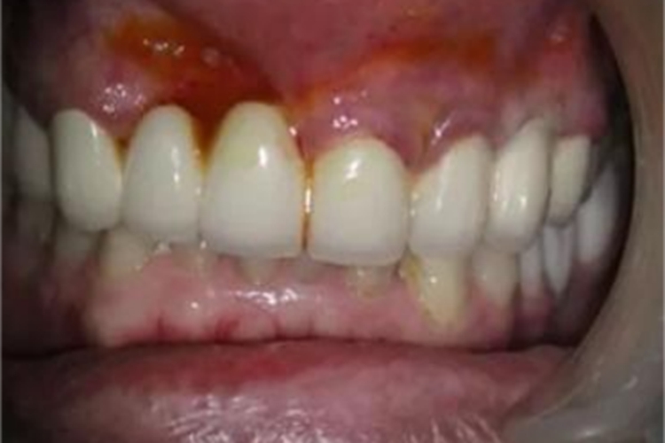 急性浆液性根尖周炎牙龈红肿图