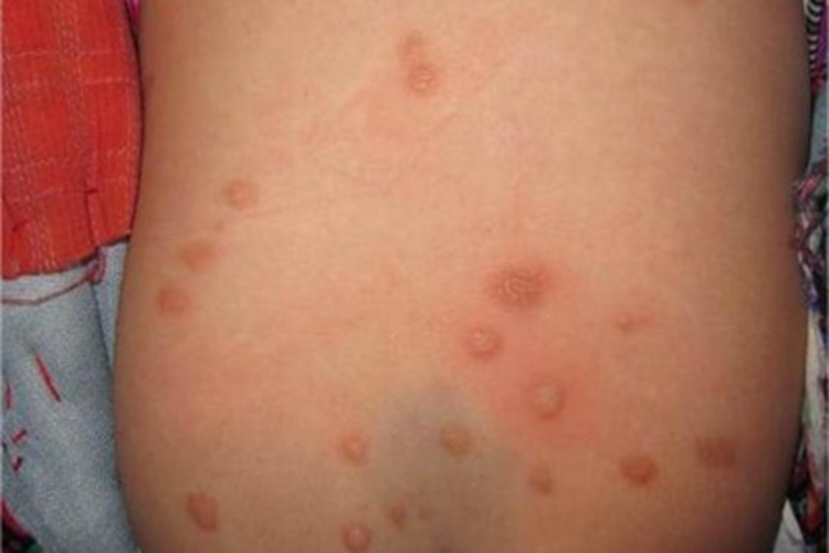 色素性荨麻疹症状图