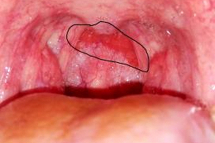 鼻咽炎咽后壁症状图