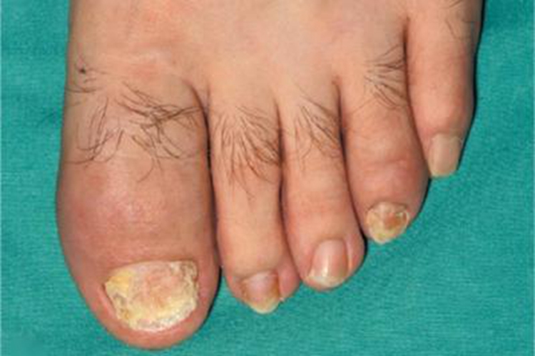 银屑病关节炎脚趾甲粗糙图 银屑病关节炎脚趾甲粗糙图