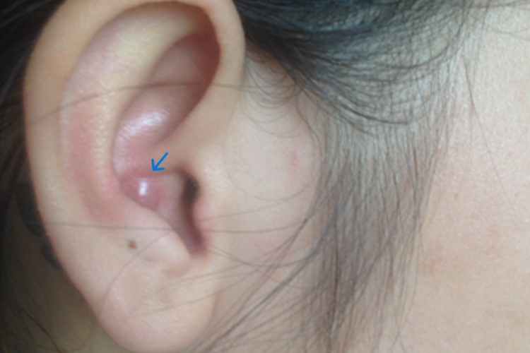 耳朵里皮脂腺囊肿图 耳朵里皮脂腺囊肿图