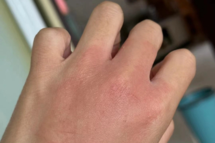 皮革皮炎手背有块发红图