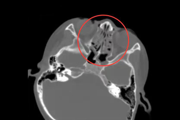 变应性鼻炎CT图