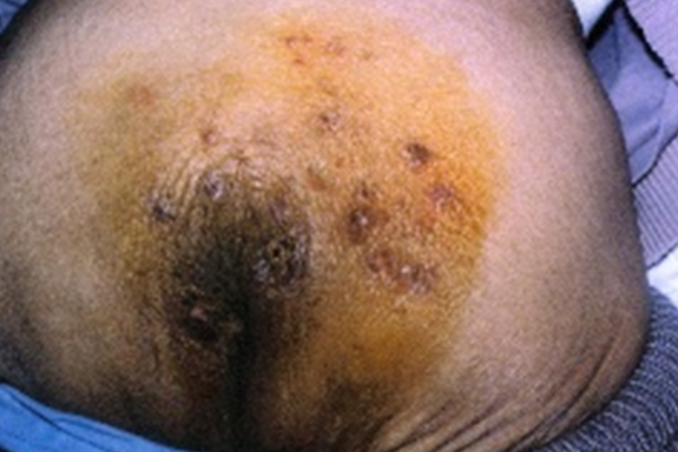 肛门及周围散在水疱图