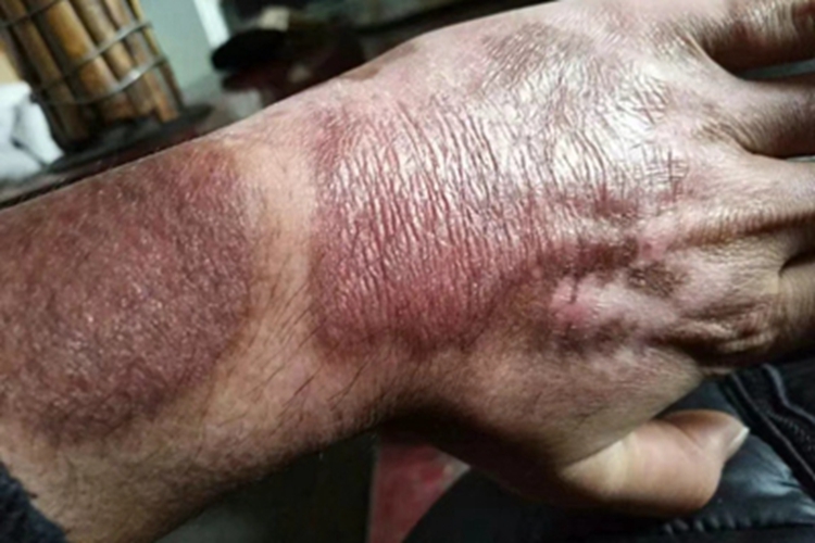 电烧伤皮肤颜色加深图 电烧伤皮肤颜色加深图