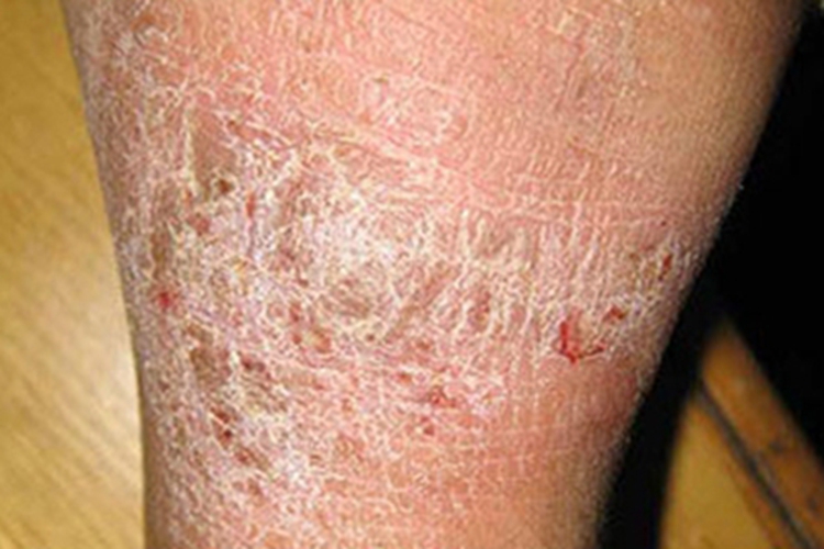 慢性湿疹小腿糜烂图