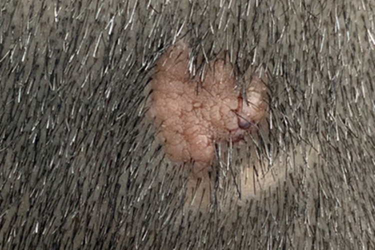 乳头状汗管囊腺瘤头皮肉粒图 乳头状汗管囊腺瘤头皮肉粒图