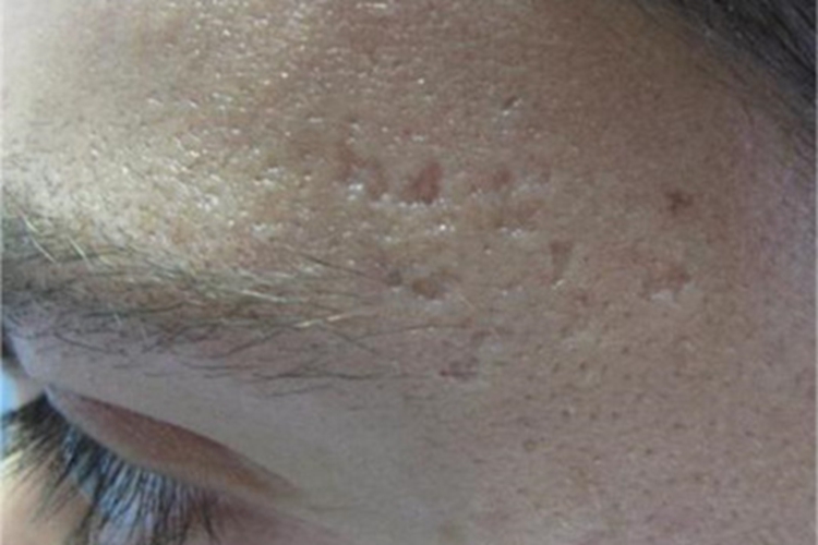 萎缩性瘢痕小坑图