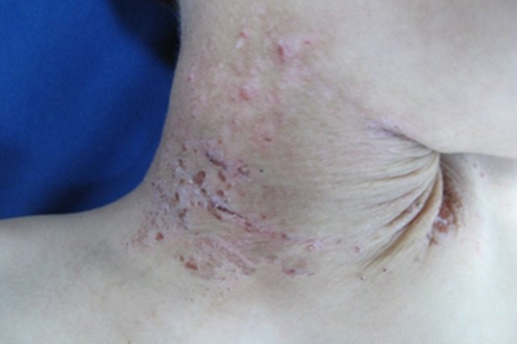 慢性放射性皮炎血痂图