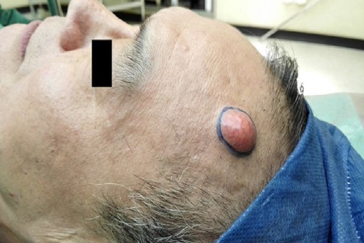 额头皮脂腺囊肿图