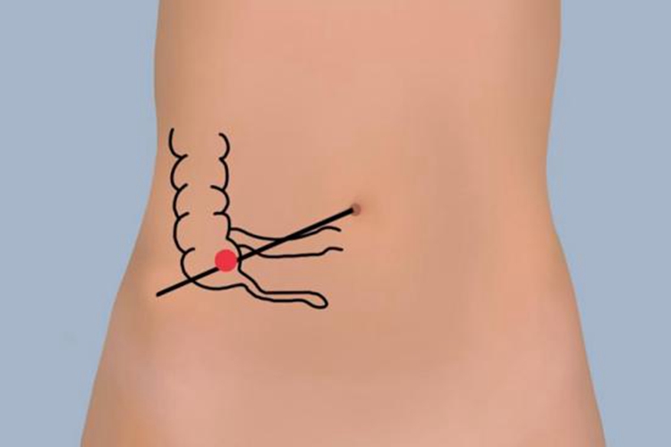 右下腹麦氏点准确的位置图