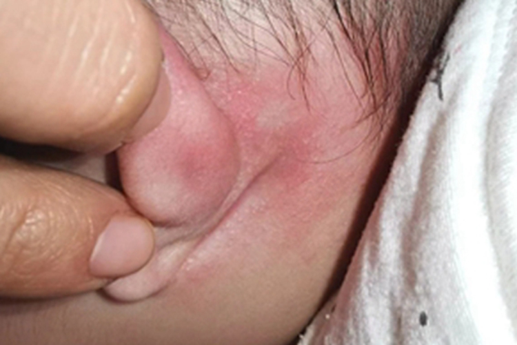 外耳湿疹耳朵后面红了一片图