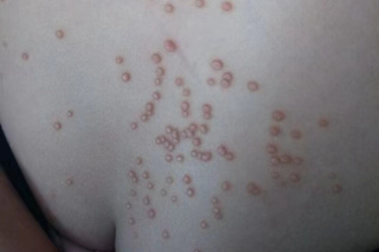 传染性软疣腰部小疙瘩图