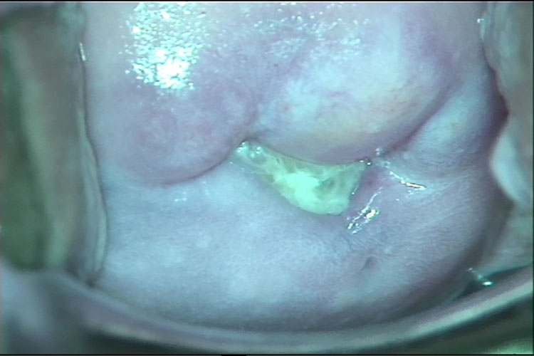 灰白色匀质鱼腥味白带图