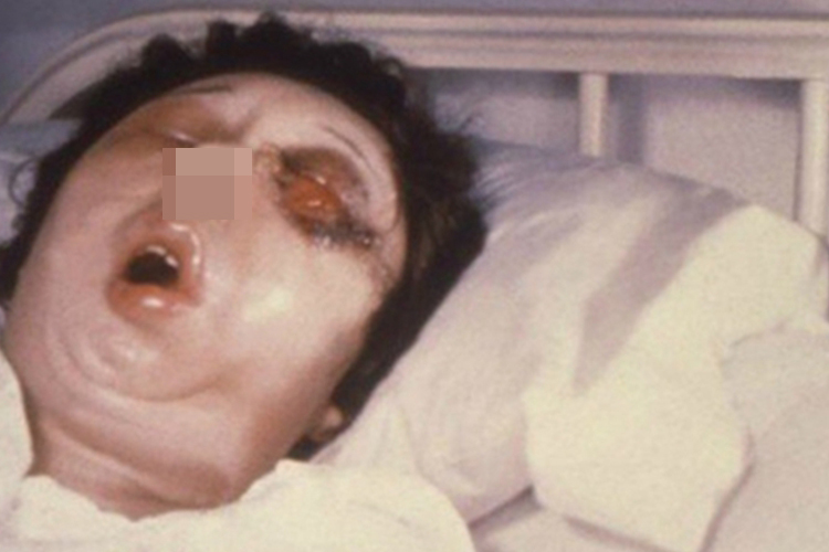 皮肤炭疽眼周糜烂图